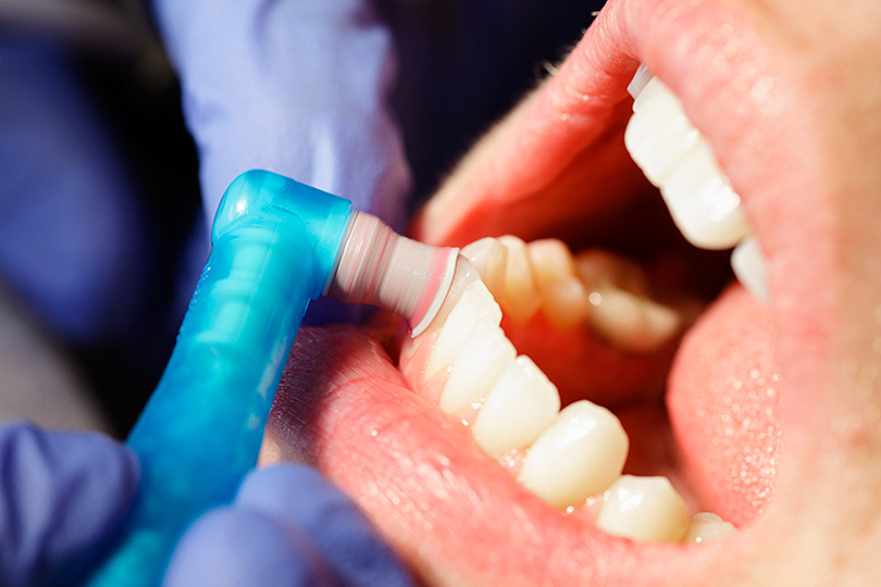 ما فائدة تنظيف الأسنان الاحترافي؟